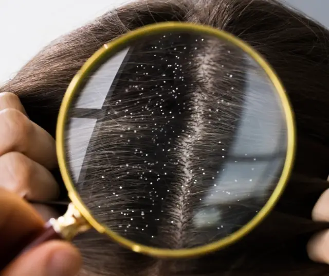 Pellicules : Causes, traitements et astuces pour les combattre