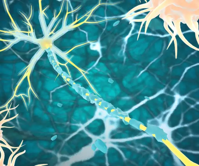 Sclérose en plaques | Diagnostic et traitements